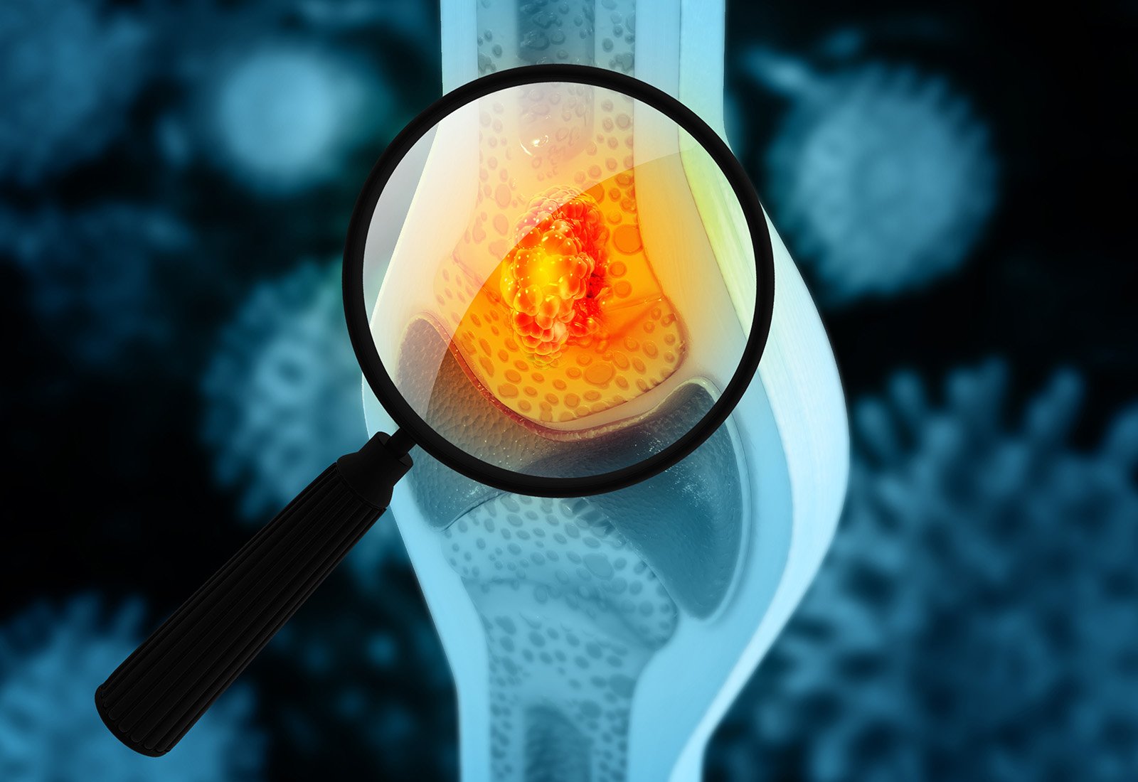 kenalan dengan kanker tulang